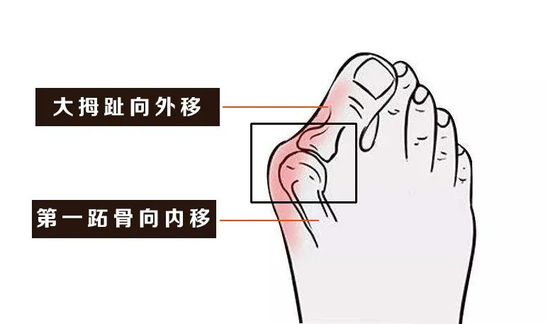 大脚「拇外翻」，让你脚趾头痛还变形！(图3)