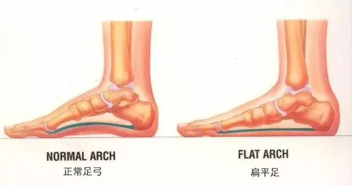 大脚「拇外翻」，让你脚趾头痛还变形！(图7)